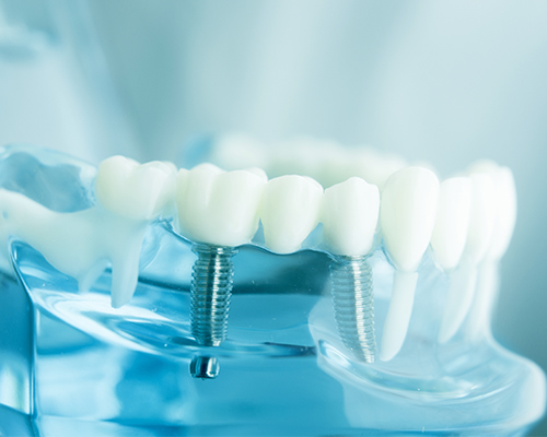feature implants